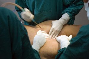 A Look Back at the History of Liposuction