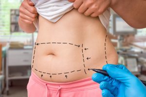 Dispelling the Myths about Tummy Tucks