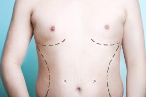 Getting the Facts about Gynecomastia