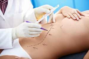Liposuction Can Complement Other Plastic Surgery Procedures