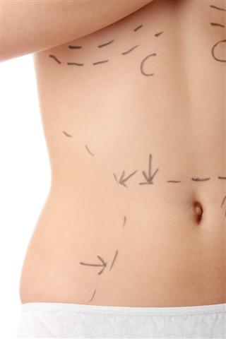 plastic surgery, mommy makeover, liposuction, tummy tuck, breast enhancement